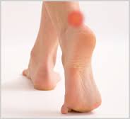 Achilles Tendon Rupture